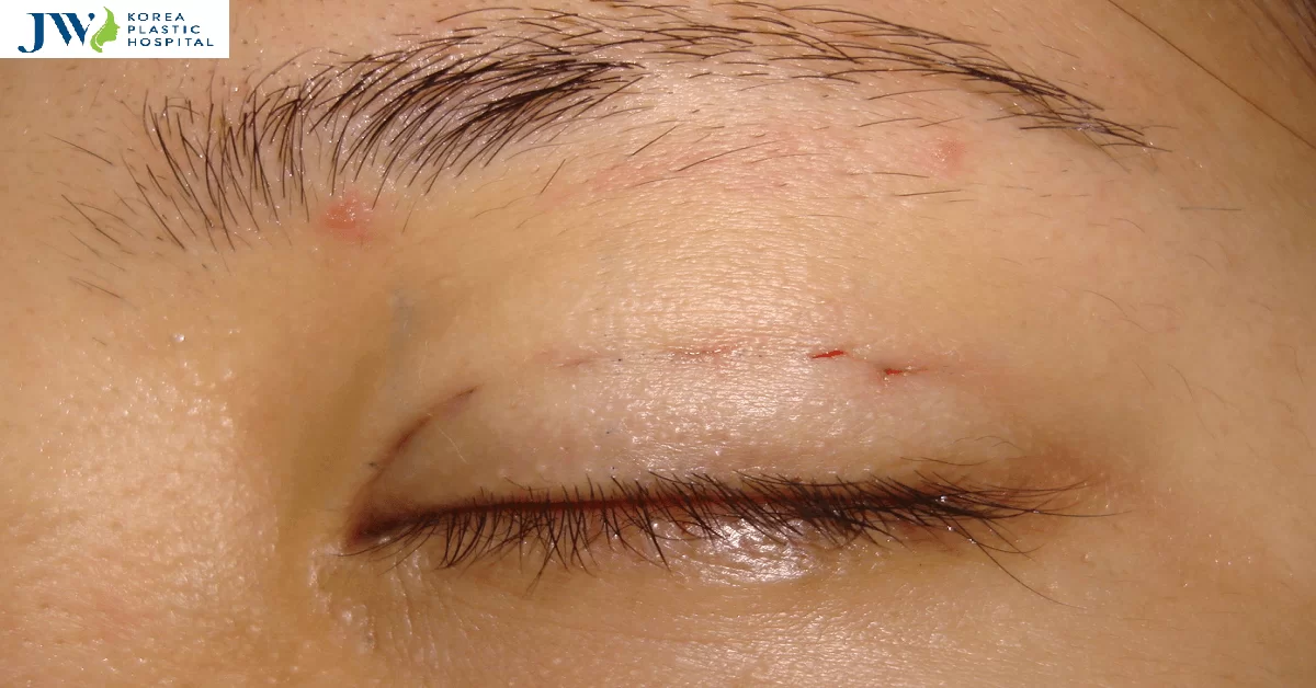 Nhấn mí bị lộ chỉ: Nguyên nhân, cách khắc phục