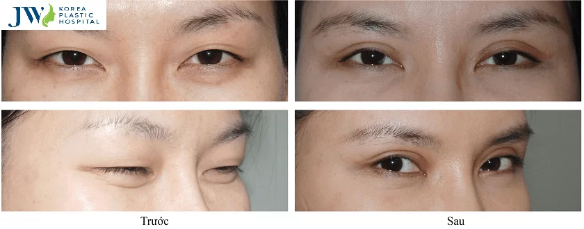 Địa chỉ nhấn mí an toàn, không đau