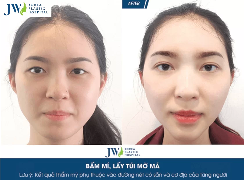 Nhấn mí giá bao nhiêu tiền tại Bệnh viện JW?