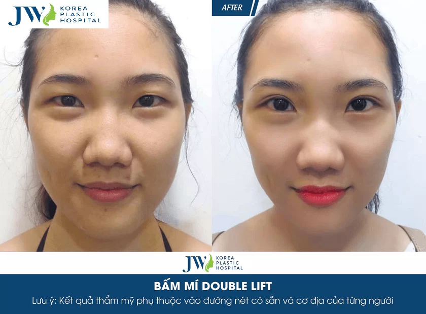 Địa chỉ nhấn mí mắt uy tín