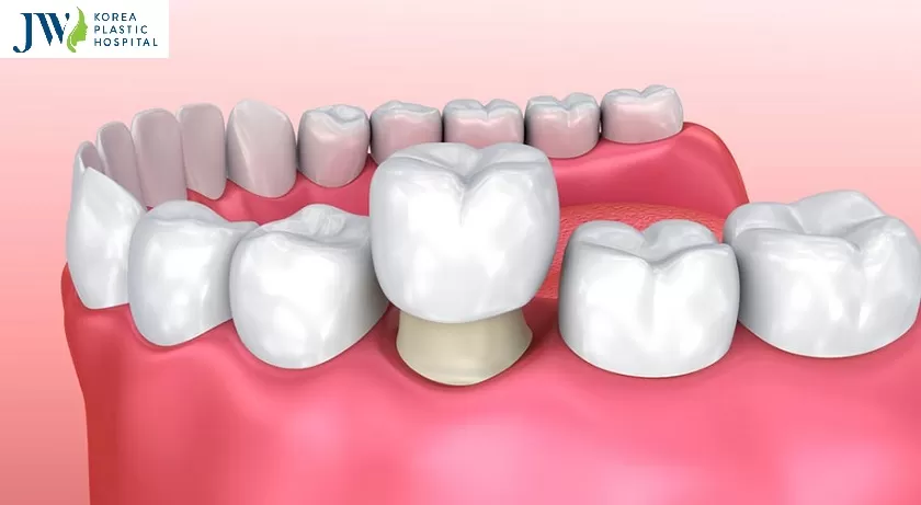 Chỉnh hàm hô không phẫu thuật