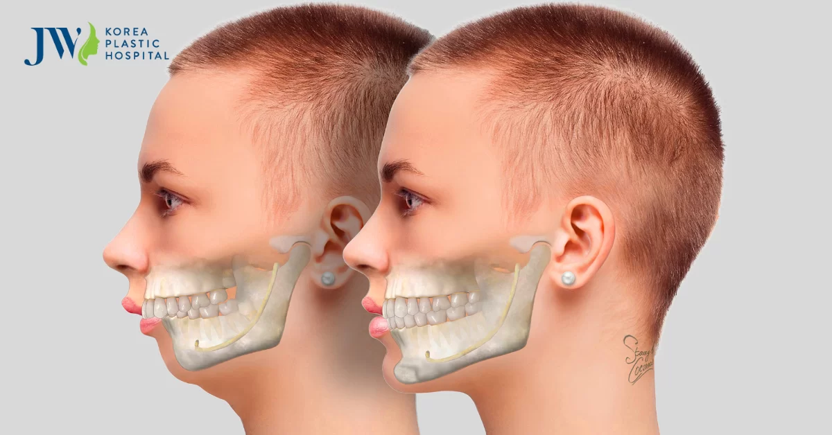 Chỉnh hàm hô móm ở đâu an toàn, uy tín? Chỉnh hàm hô có đau không?