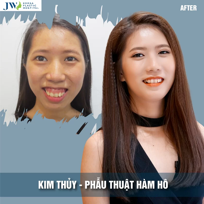 cong-nghe-phau-thuat-ho-mom-toan-dien