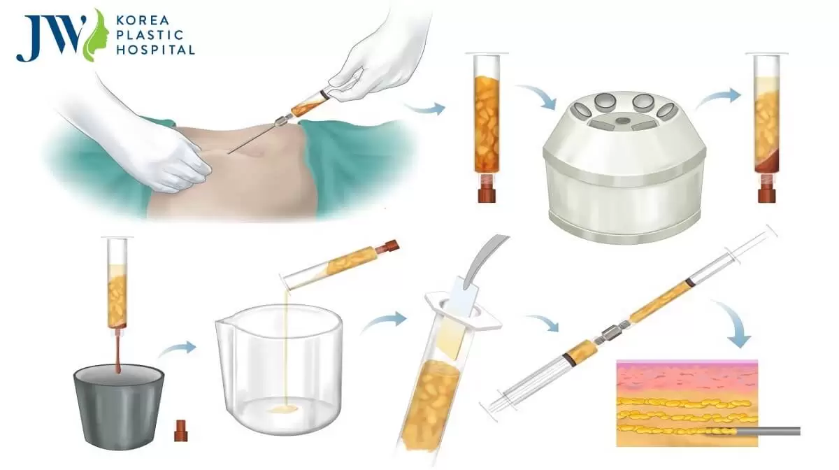Công nghệ Puregraft chìa khóa cho sự thành công trong cấy ghép mỡ