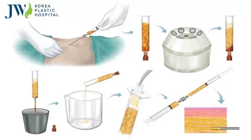 cong-nghe-puregraft