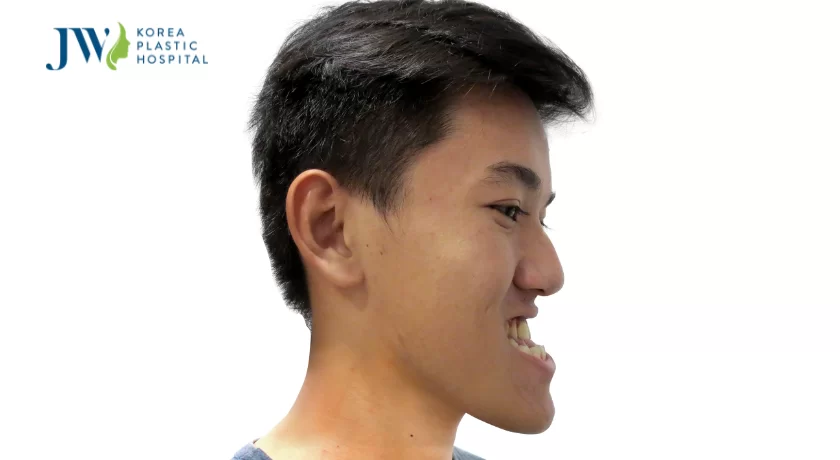hàm móm có di truyền không