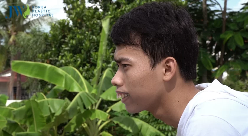 răng hô móm niềng hay phẫu thuật