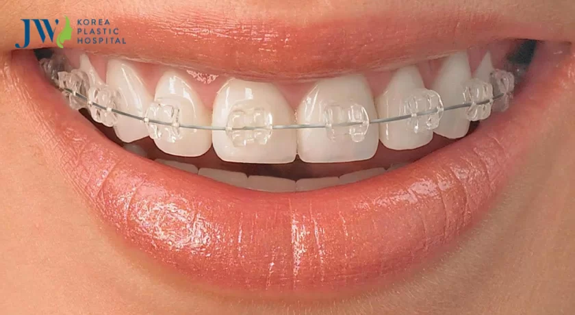 hô móm nên niềng răng hay phẫu thuật