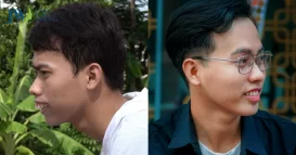 hô móm niềng hay phẫu thuật