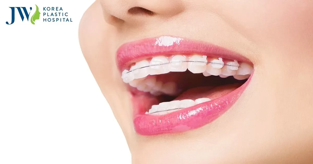 Giải đáp thắc mắc sự thật niềng răng có hết hô hàm không?