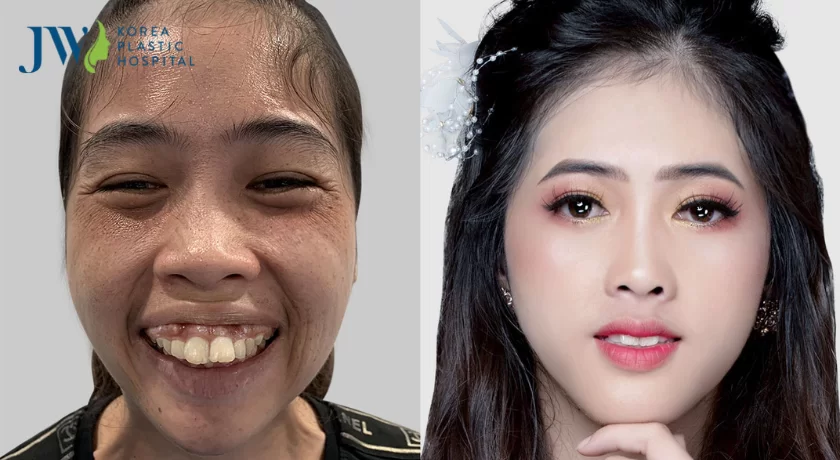 phẫu thuật cắt hàm hô