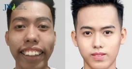 phẫu thuật cắt hàm hô