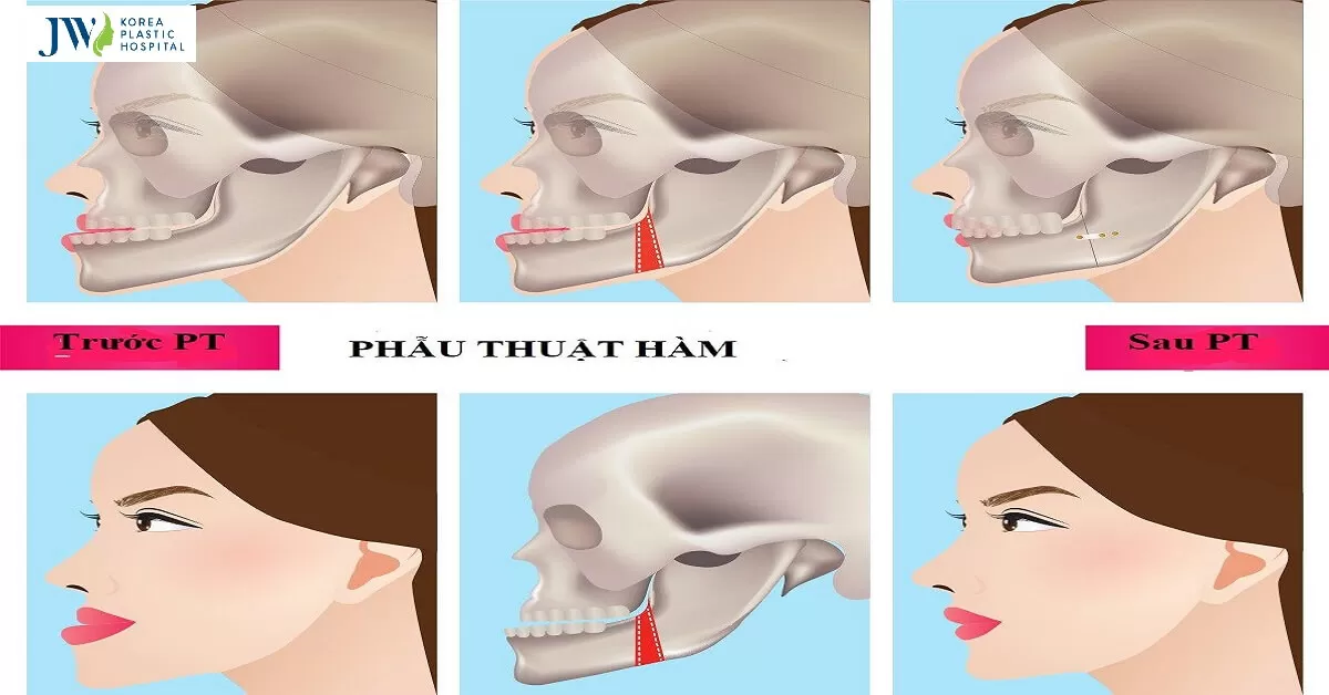 Phẫu thuật cắt hàm có để lại di chứng hay không?
