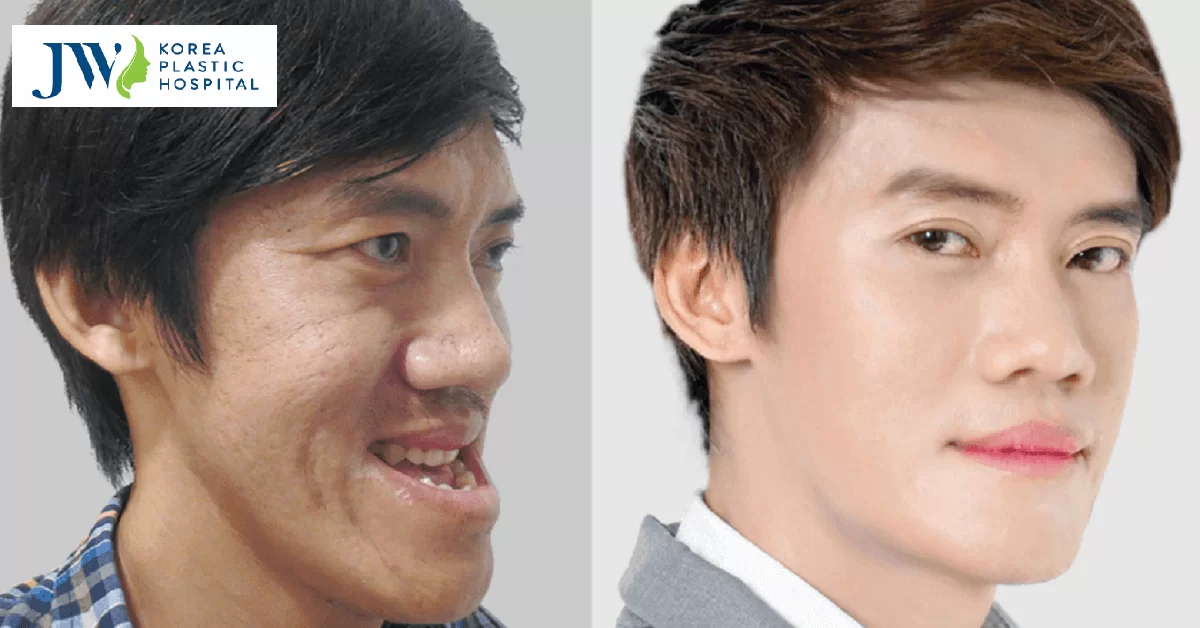 Những điều cần nên biết trước khi phẫu thuật cắt xương hàm