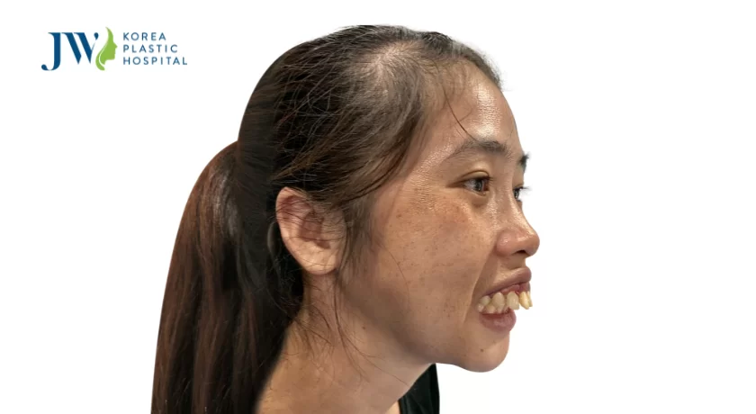 phẫu thuật hàm hô