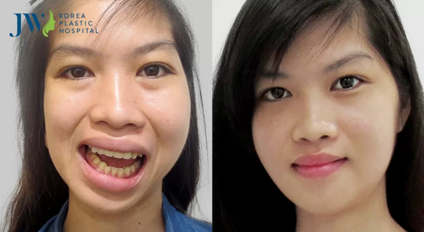 phẫu thuật chỉnh hàm lệch