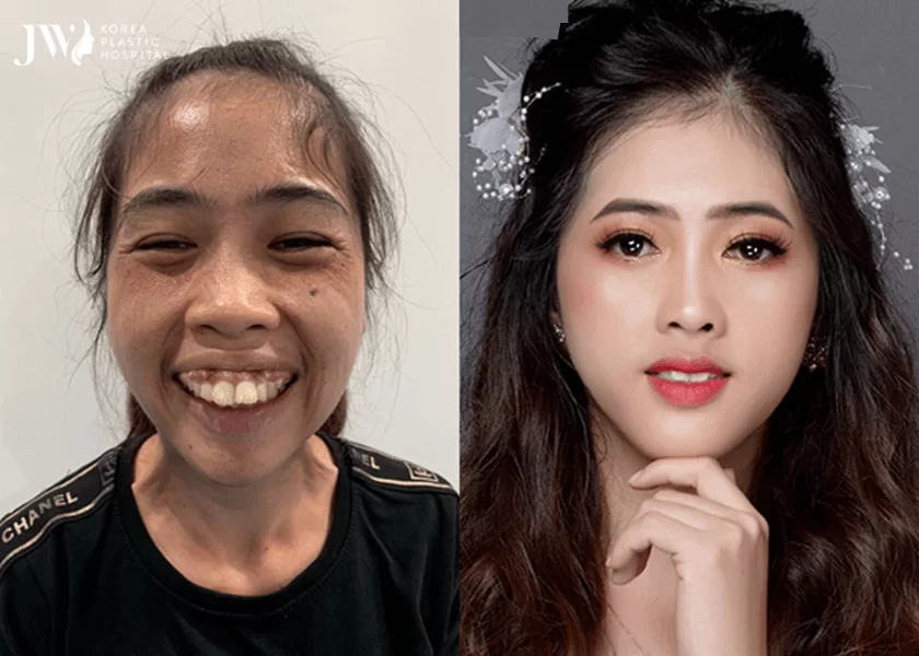 Lợi ích của phẫu thuật hàm hô cười hở lợi