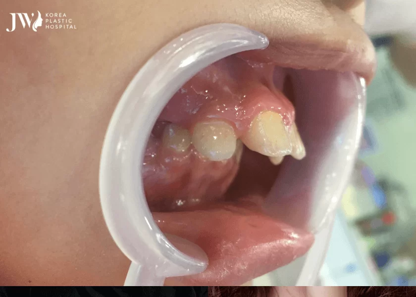Phẫu thuật hàm hô cười hở lợi là gì?