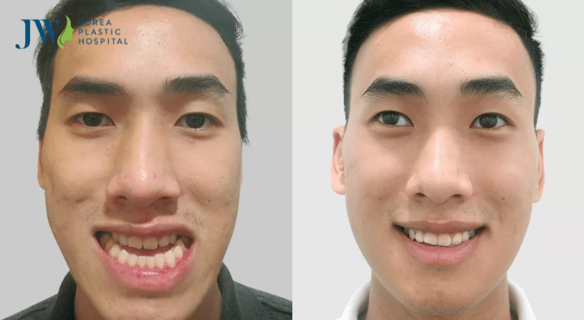 phẫu thuật thẩm mỹ răng hàm mặt