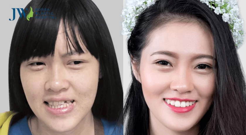 phẫu thuật thẩm mỹ răng hàm mặt
