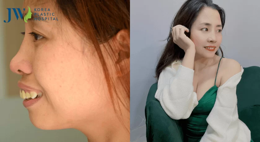 chỉnh sửa hàm hô
