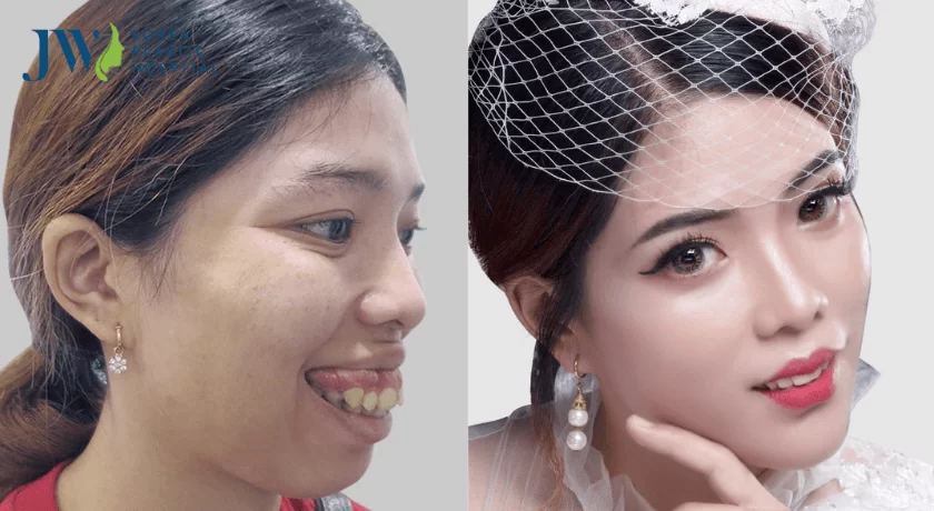 quy trình phẫu thuật hàm hô