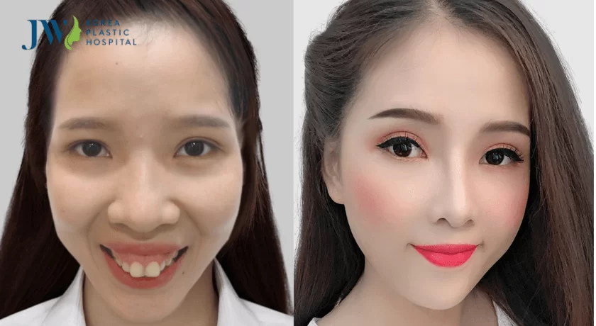phẫu thuật hàm hô chuẩn y khoa