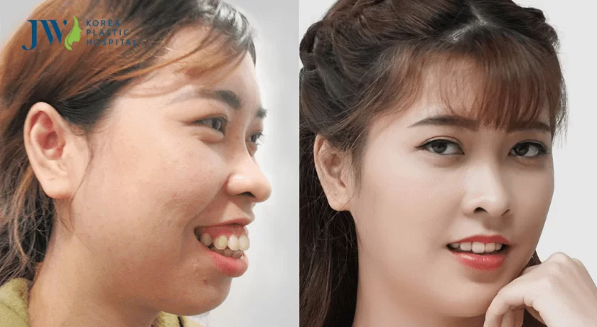 quy trình phẫu thuật hàm hô