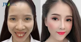 quy trình phẫu thuật hàm hô