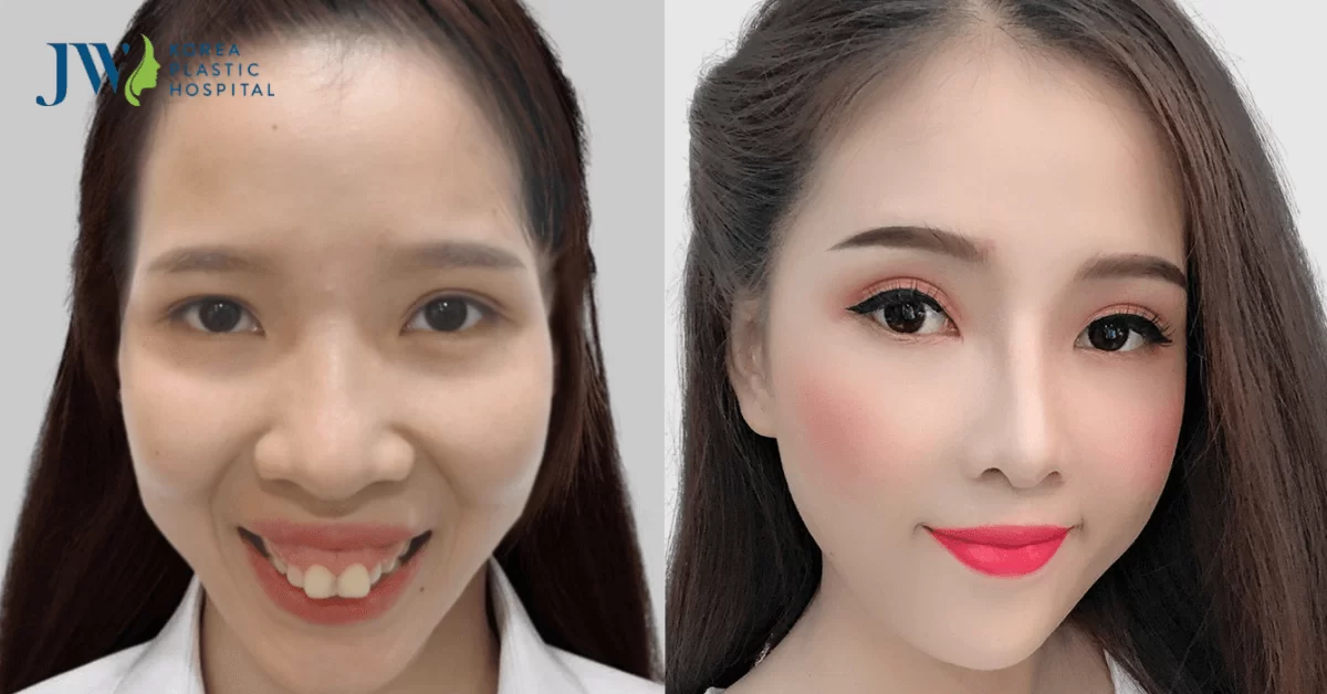 Quy trình phẫu thuật hàm hô đúng chuẩn y khoa tại Bệnh viện JW