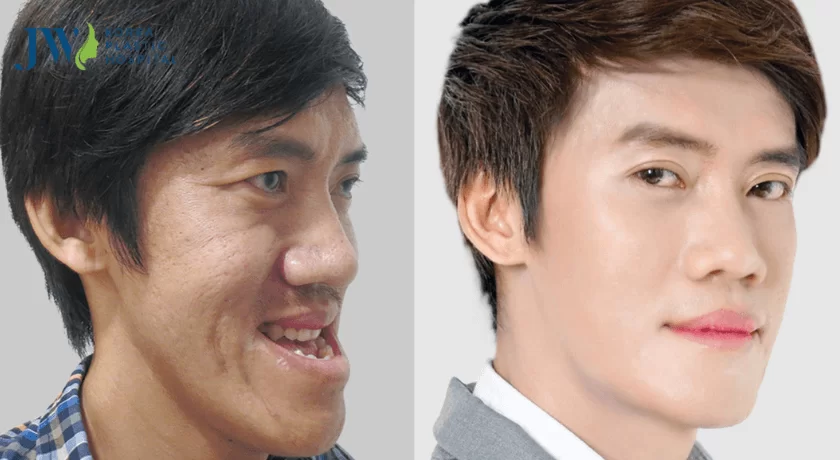 sửa hàm móm