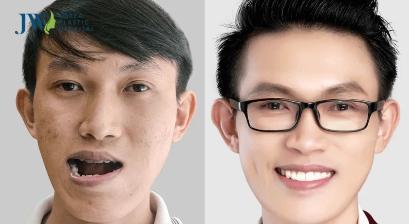phương pháp chỉnh sửa sửa hàm móm