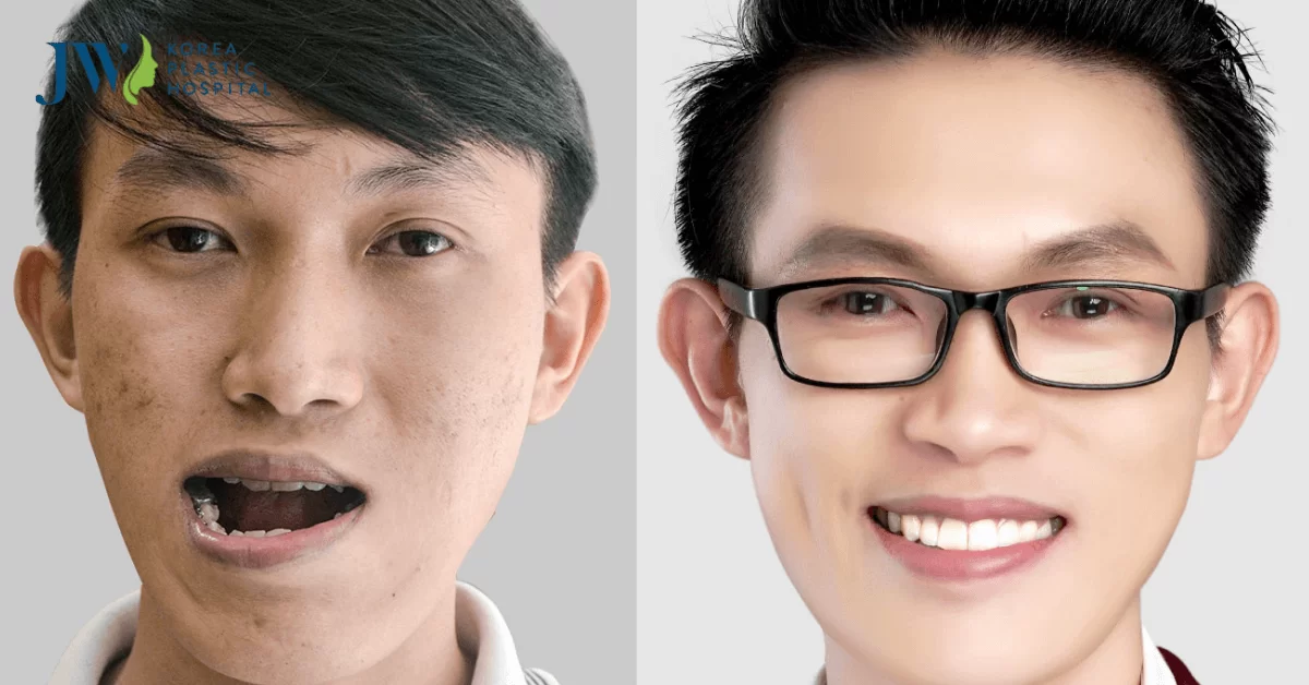 Sửa hàm móm là gì? Các phương pháp sửa hàm móm hiện nay