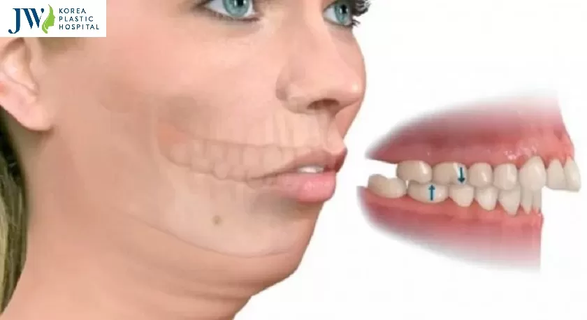 thẩm mỹ hàm hô bằng phẫu thuật