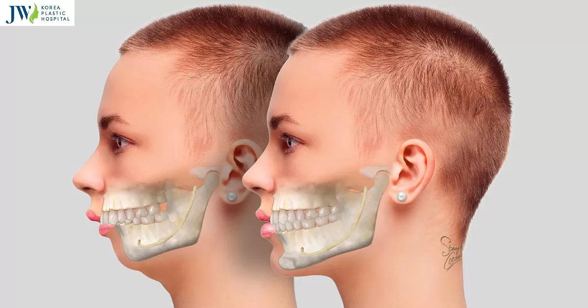 Phẫu thuật hàm hô hiện nay có chi phí là bao nhiêu