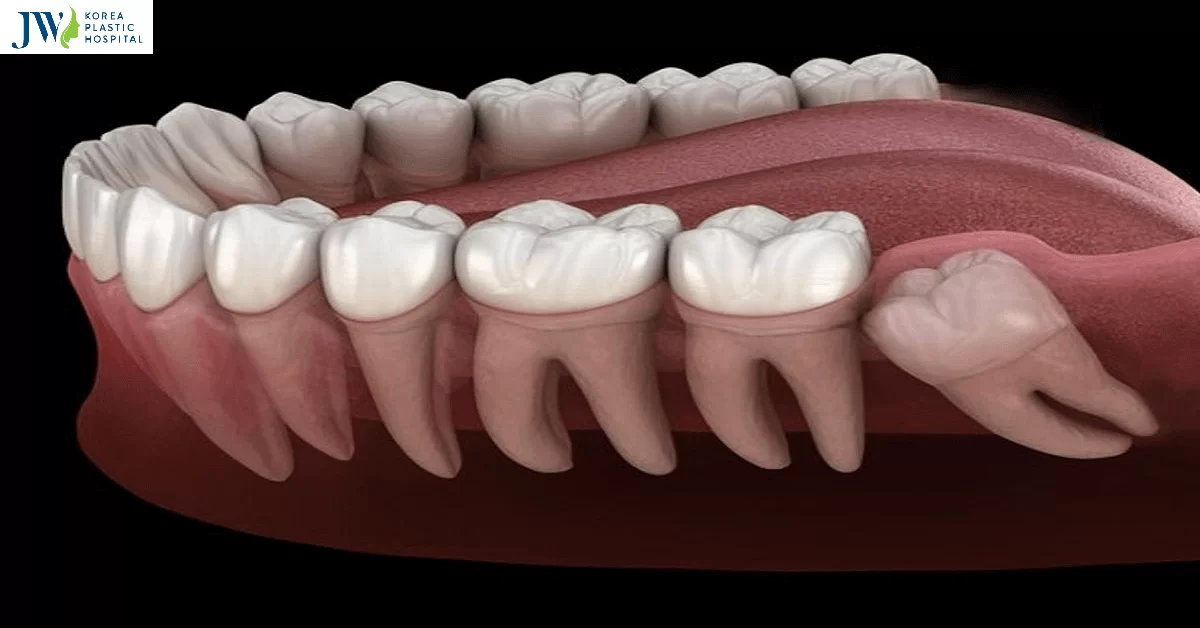 Phẫu thuật răng khôn và những kiến thức cần phải chuẩn bị