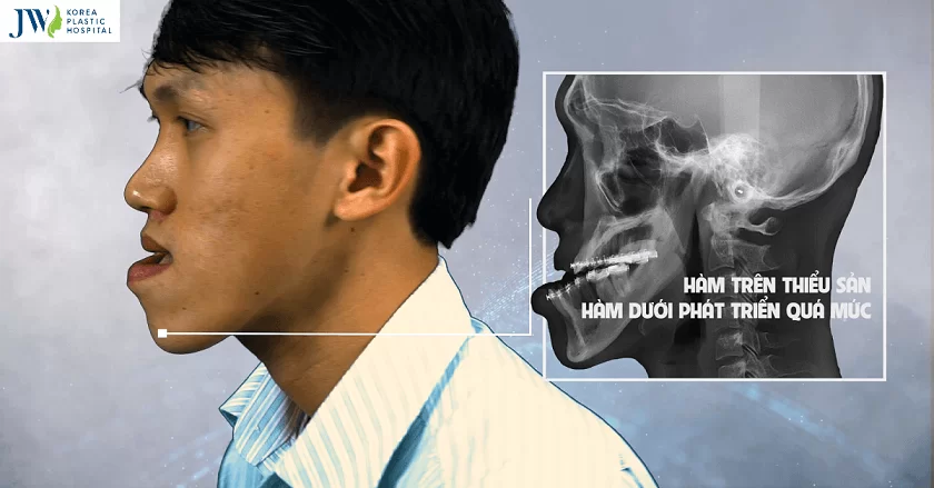 phau thuat xuong ham duoi