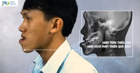 phau thuat xuong ham duoi