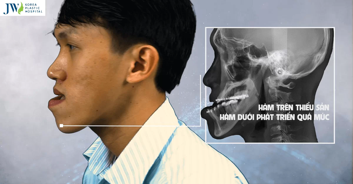 Phẫu thuật xương hàm dưới để điều trị lệch lạc khớp cắn