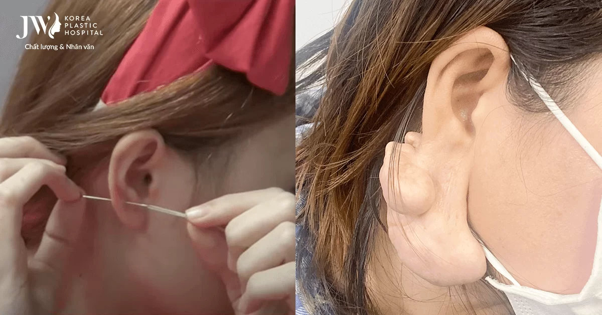 Dùng kim may vá xỏ lỗ tai, người phụ nữ bị u phì đại nặng 0,5 kg suốt 10 năm