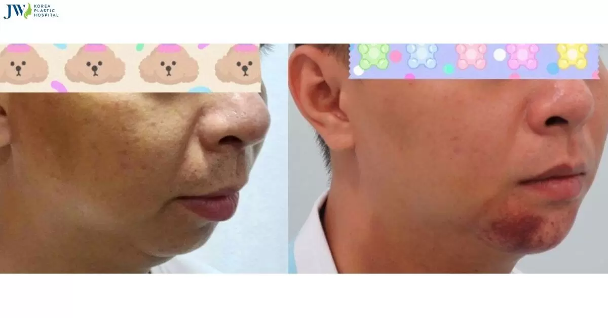 Quy trình chăm sóc bệnh nhân sau phẫu thuật tạo hình cằm (ASO)