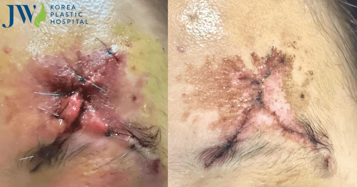 Sự kì diệu của tế bào gốc trong việc điều trị vết thương hở tét trán