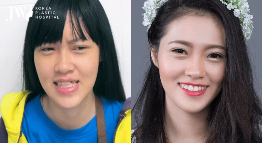 phẫu thuật hàm mặt