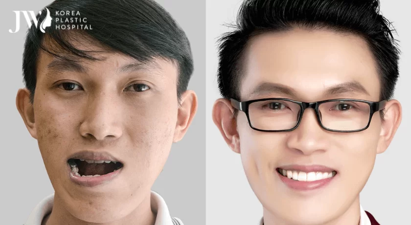 phẫu thuật hàm móm an toàn