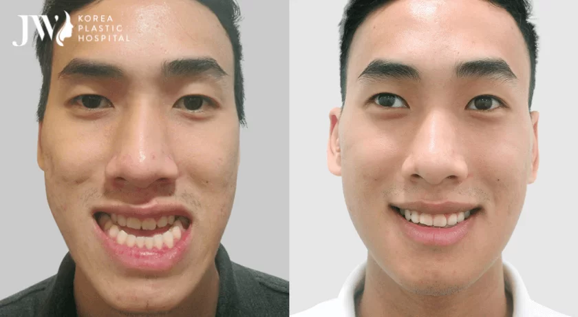 Phẫu thuật hàm móm BSSO