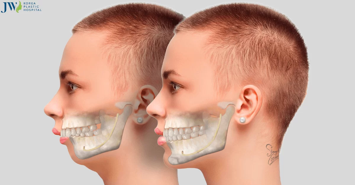 Quy trình chăm sóc bệnh nhân phẫu thuật hàm hô tiền đình hàm (ASO)