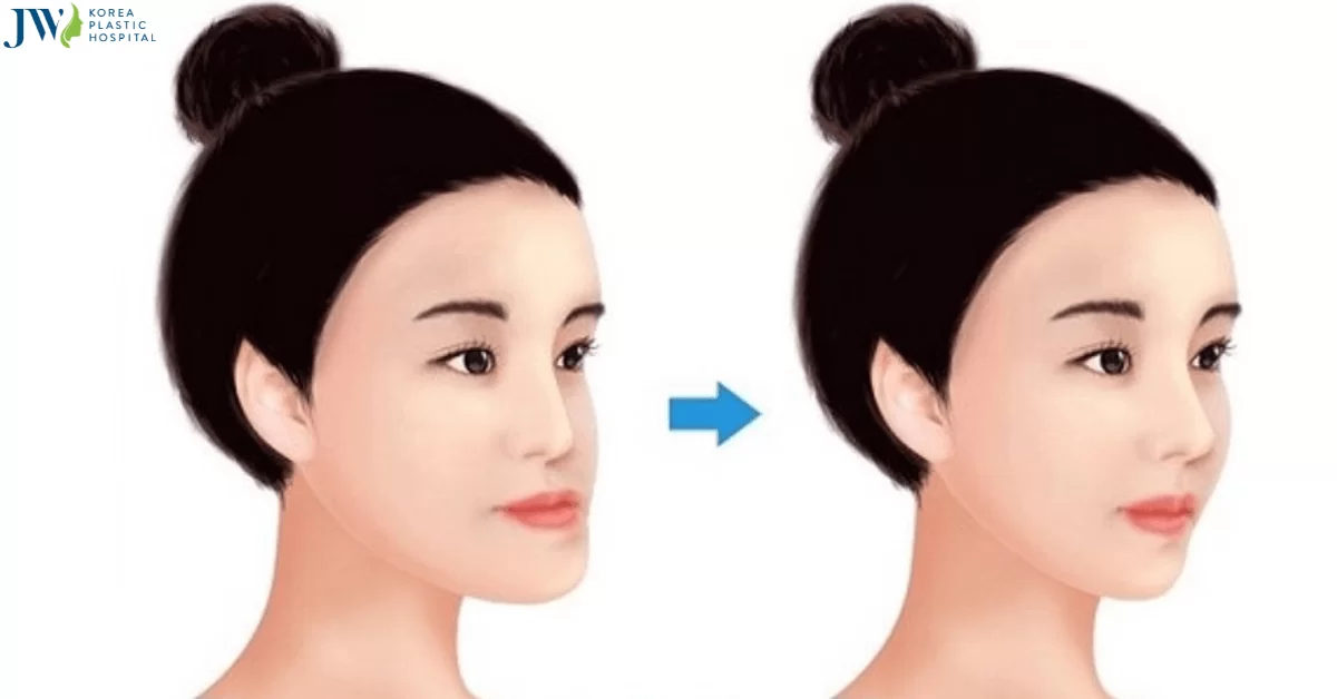 Quy trình chăm sóc bệnh nhân nhân Phẫu thuật Lefort I