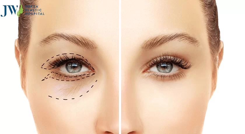 Cắt mắt hai mí và quy trình chăm sóc