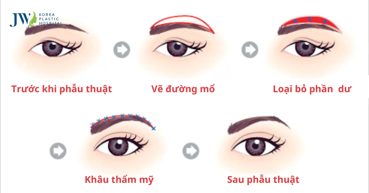 Quy trình chăm sóc bệnh nhân treo cung mày