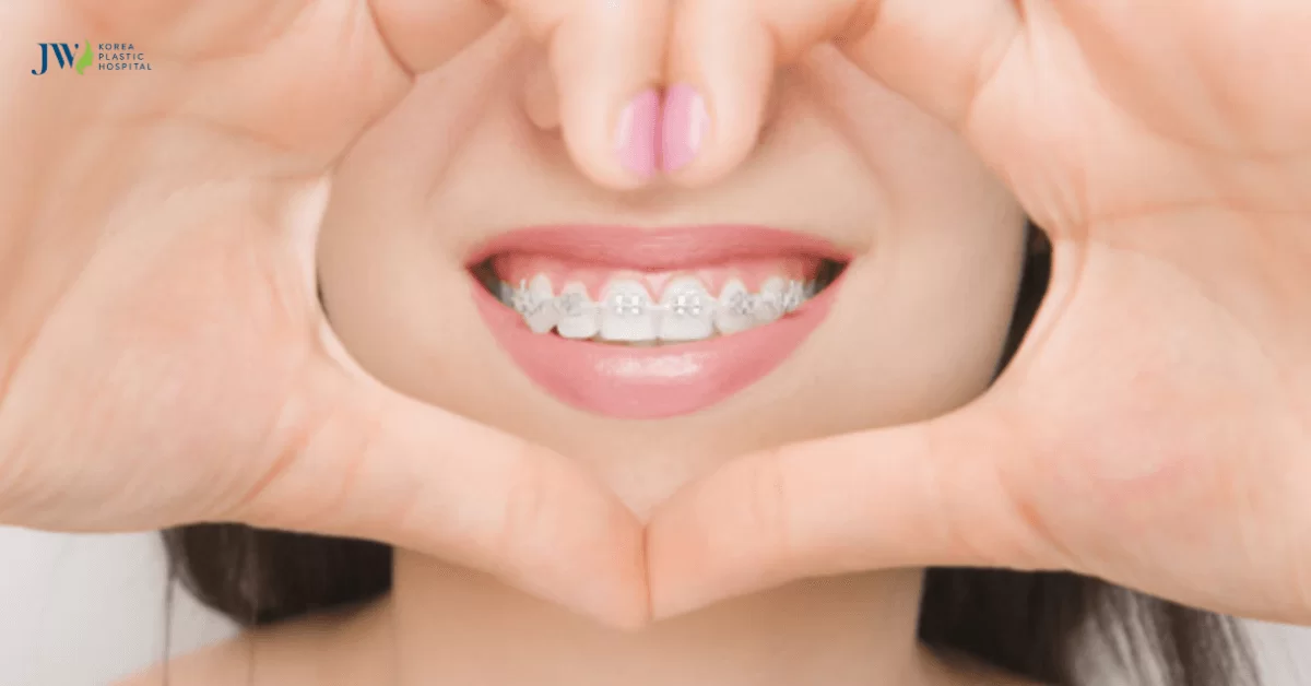 20 tuổi niềng răng được không? Bao lâu thì đạt hiệu quả?